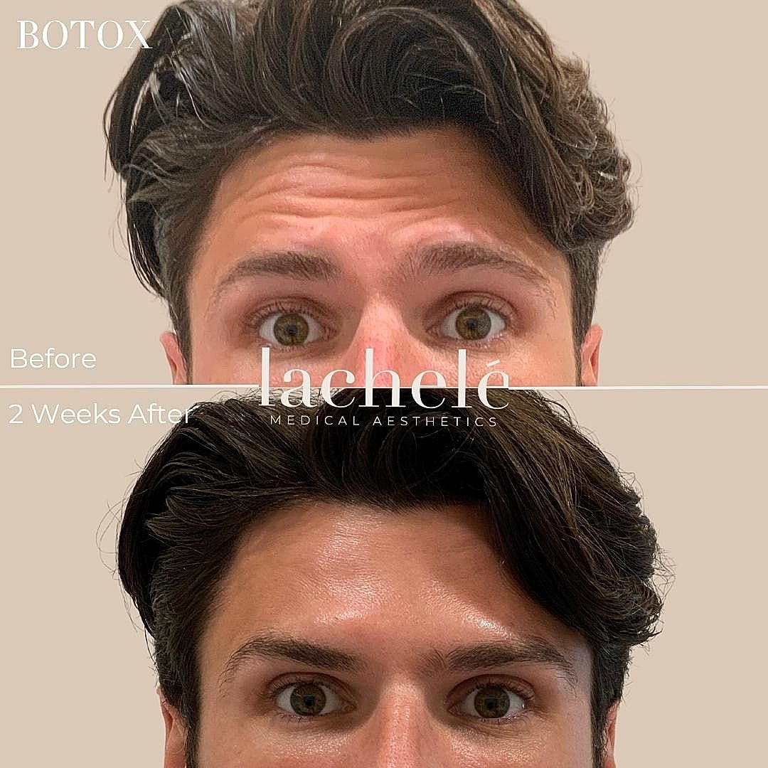 Botox transformation before and after photos.