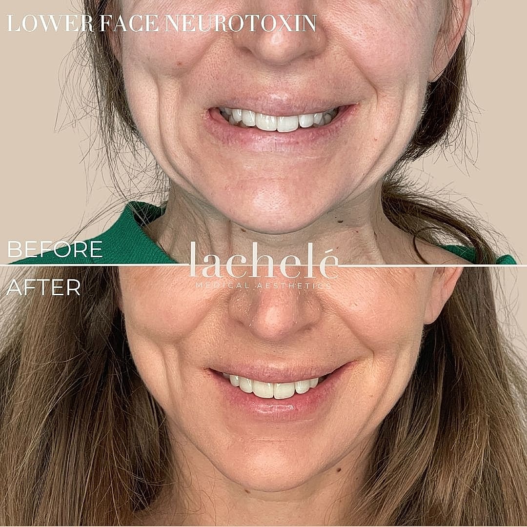 Before and after facial neurotoxin treatment.