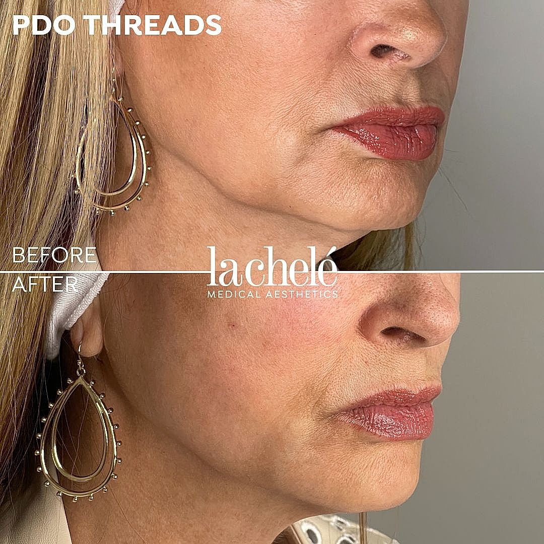 PDO threads before and after treatment comparison.
