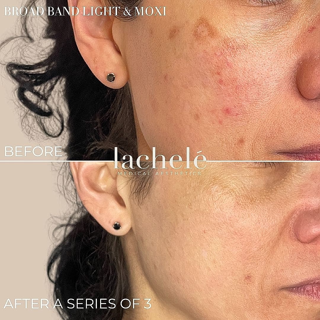 Before and after skin treatment results comparison.