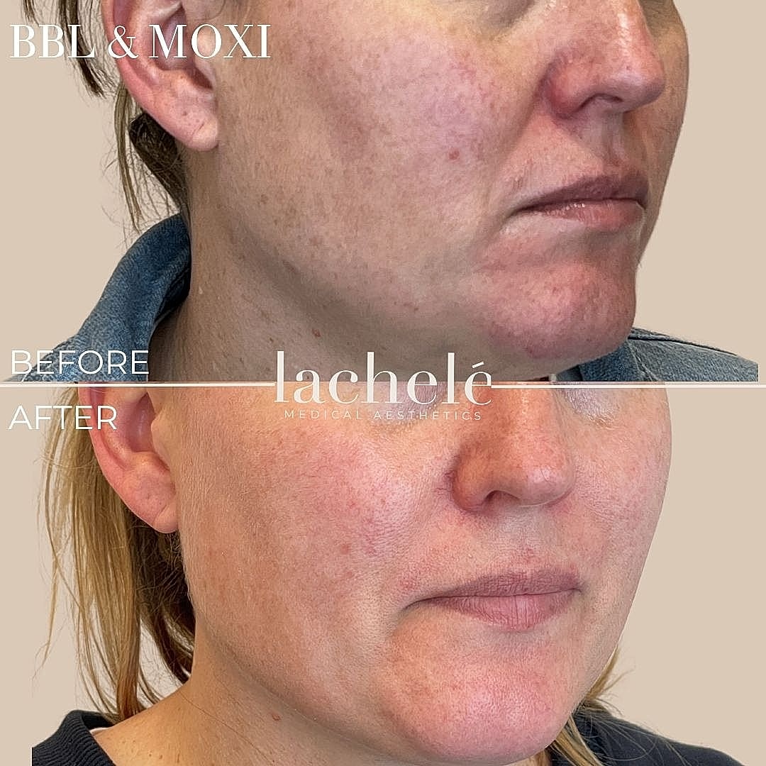BBL and Moxi treatment before and after comparison
