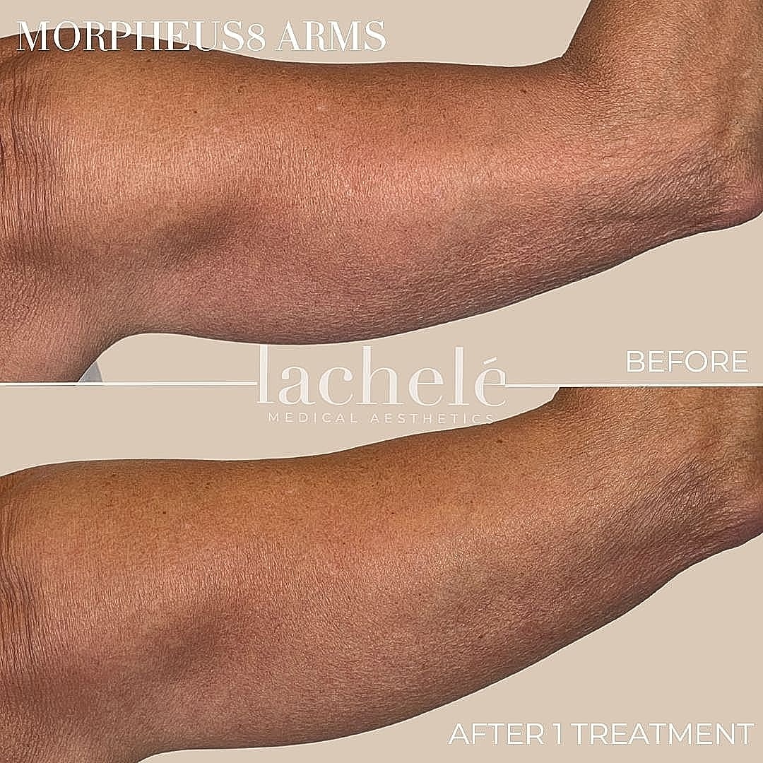 Morpheus8 treatment results for arm rejuvenation.