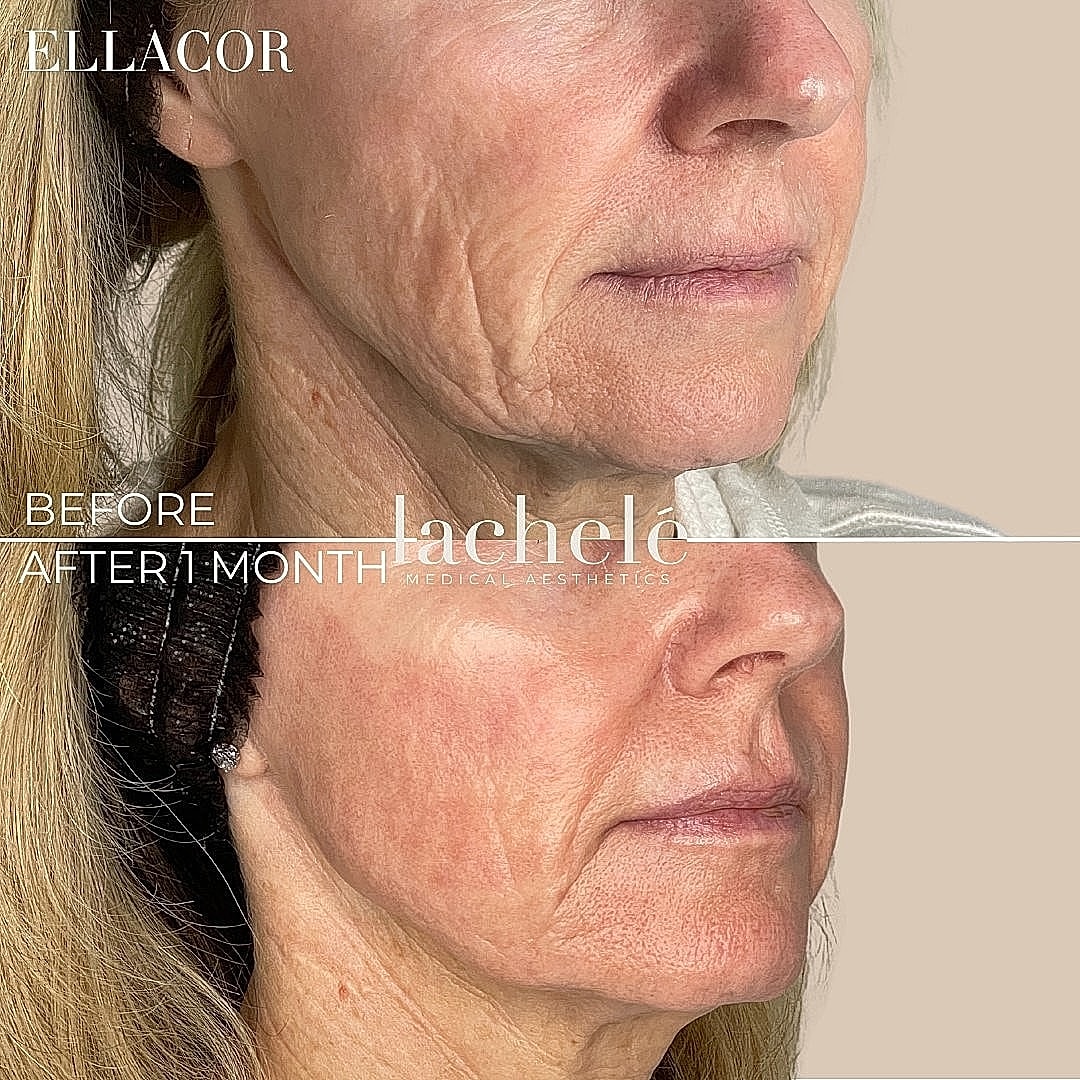 Before and after skin treatment results comparison.