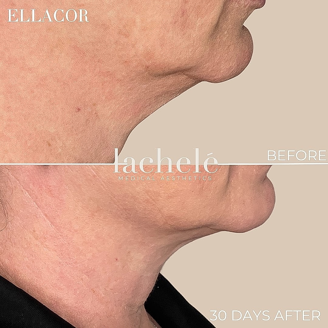 Before and after neck treatment comparison image.