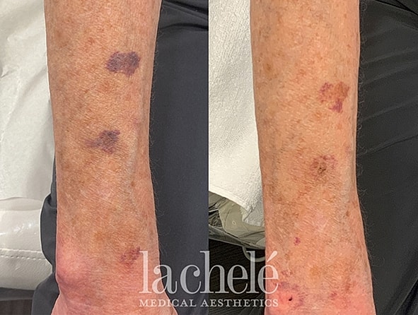 Before and after skin treatment on arms.