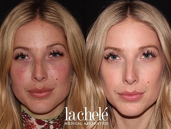 Before and after skin treatment comparison image.