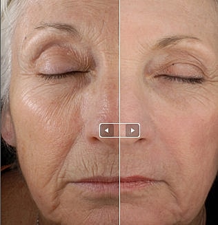 Before and after anti-aging treatment comparison
