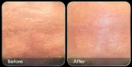 Comparison of skin before and after treatment.