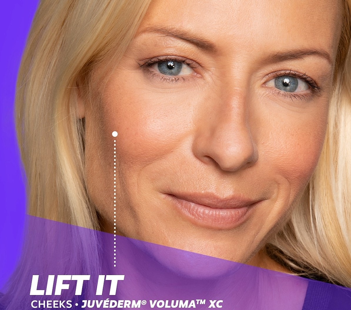 Woman showcasing cheek volume treatment advertisement.