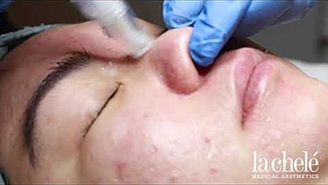 Microneedling treatment on a client's face.