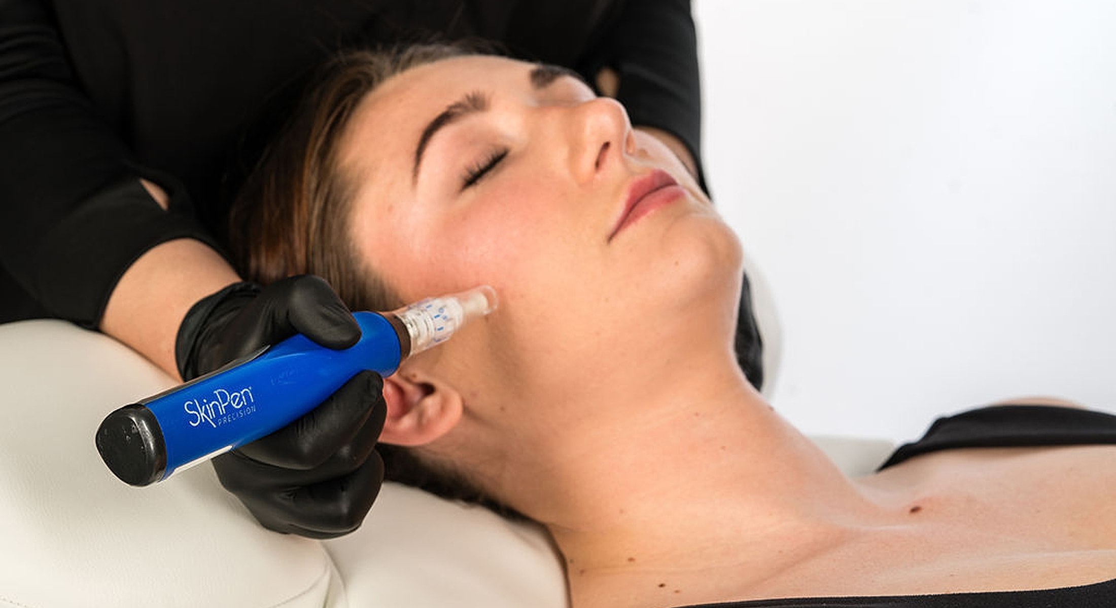 Skin treatment with a microneedling device.