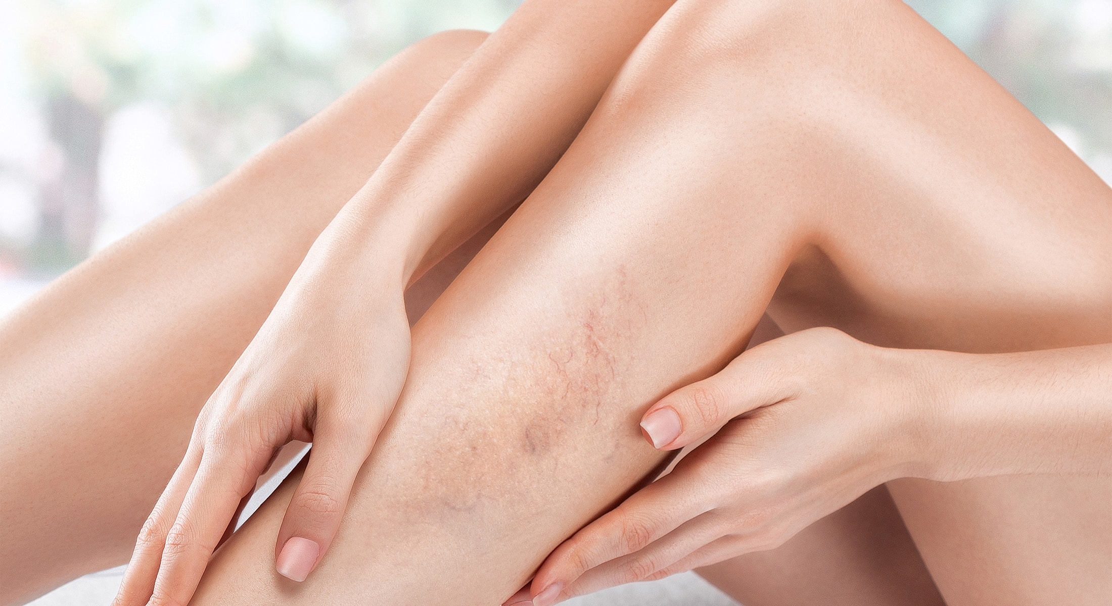 Close-up of hands on leg with skin imperfections.